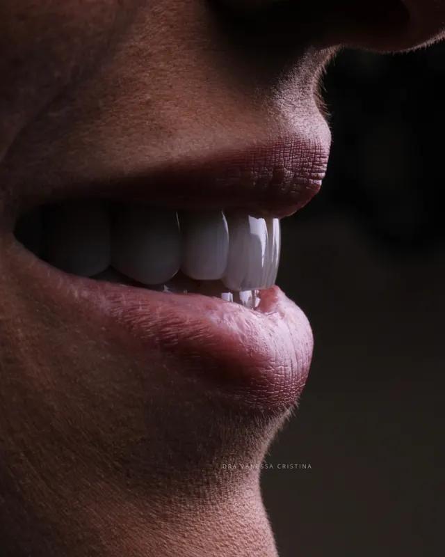 Perfil de sorriso com lentes